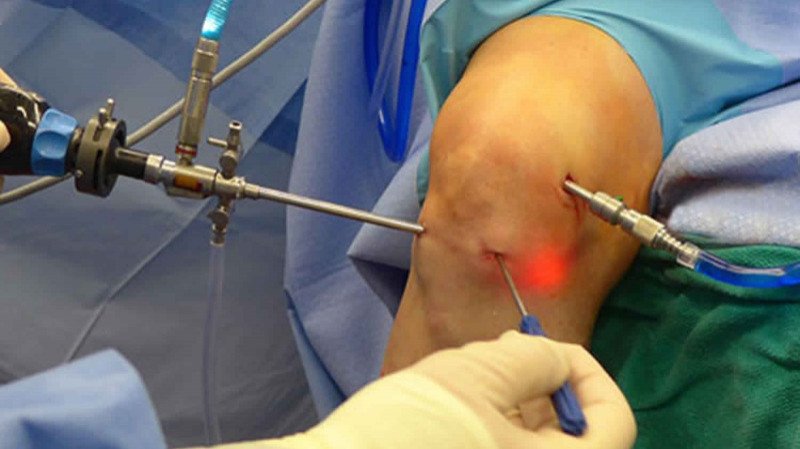 detail main arthroscopic knee surgery