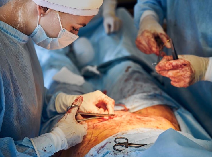 doctor assistant stitching up wound after abdominoplasty surgery 651396 3086