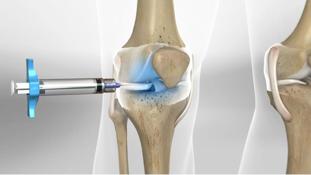 Ácido hialurónico para la rodilla