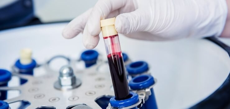 platelet rich plasma preparation tube with blood hands 179755 10340 e1784267018346