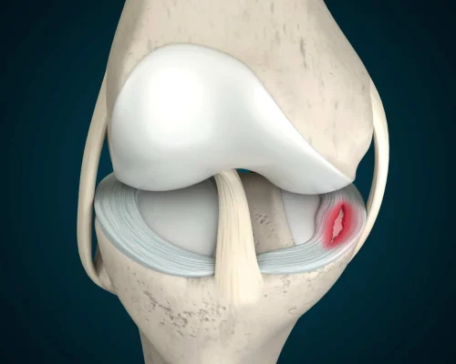 3D-rendering-of-meniscus-tear